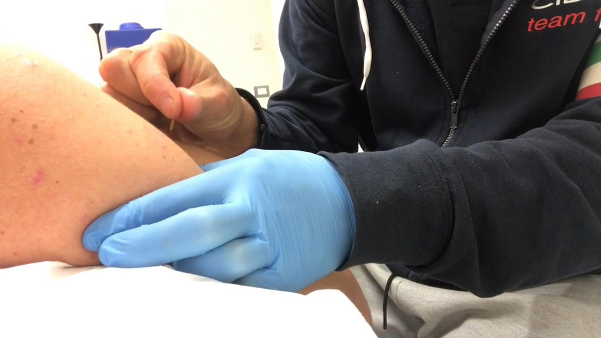 Dry Needling